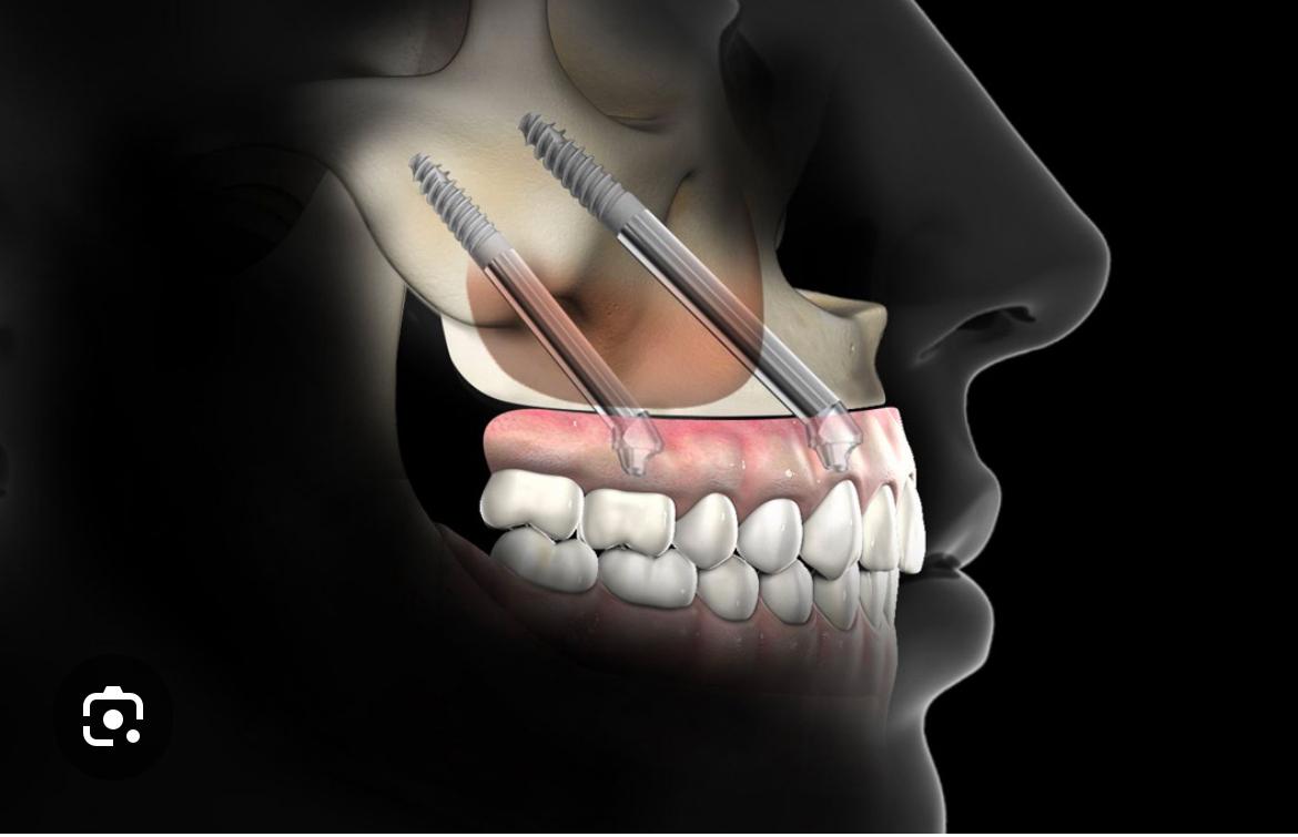 Immagine WhatsApp ore - ricerca - impianti-dentali-senza-osso